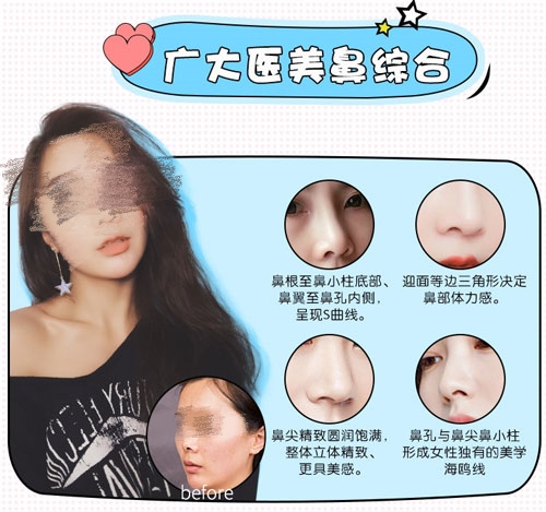 佛山广大整形医院鼻综合案例
