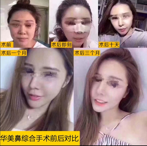 佛山华美医院隆鼻案例