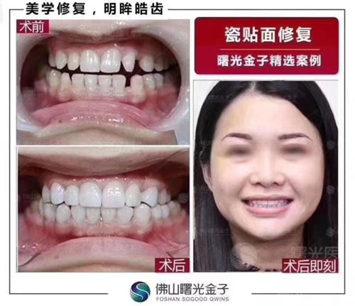佛山曙光金子口腔案例