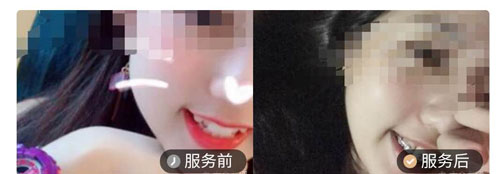 佛山华美牙齿矫正案例