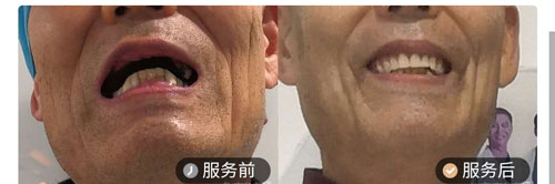 佛山华美口腔牙齿种植案例