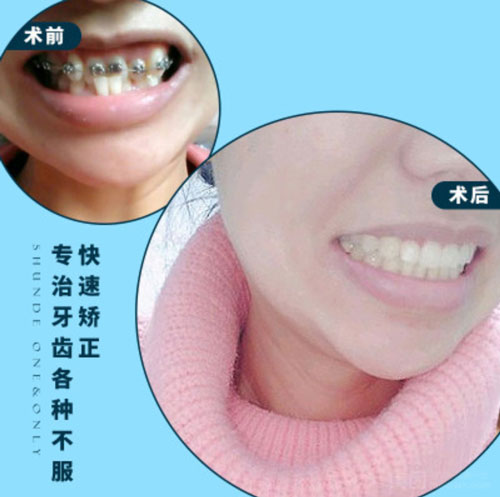 佛山壹加壹口腔牙齿矫正案例