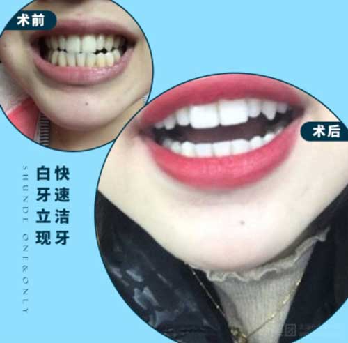 佛山壹加壹口腔洁牙案例
