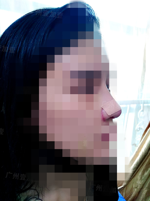膨体+肋软骨隆鼻术后一个月恢复全过程