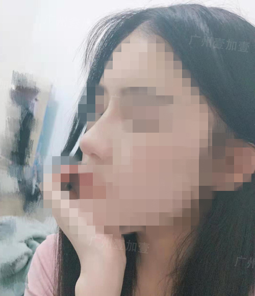 广州李明膨体隆鼻效果怎么样
