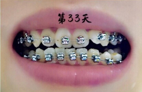 牙齿金属托槽矫正第33天