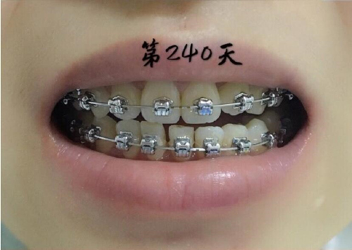 牙齿金属托槽矫正第240天