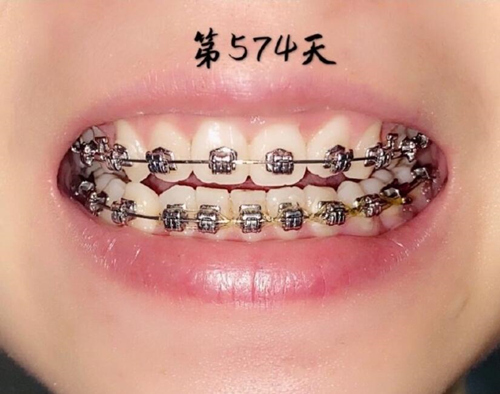 牙齿金属托槽矫正第574天