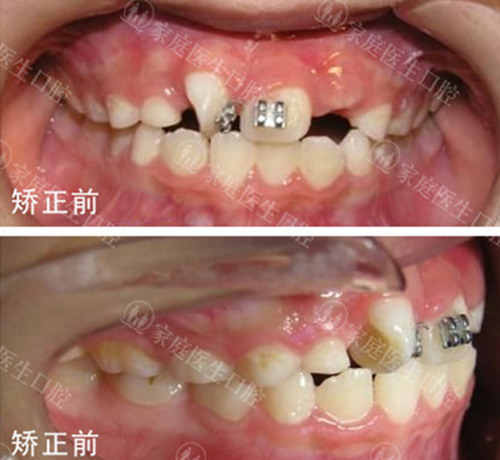 广州中家医家庭医生口腔矫正案例分享