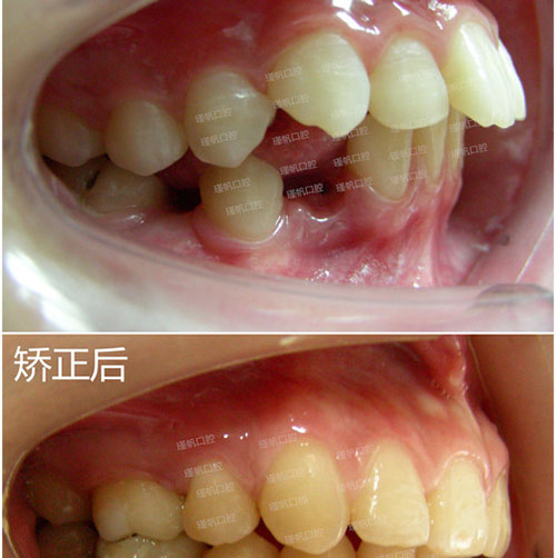 桂林瑾帆口腔医院牙齿矫正案例