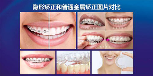 桂林瑾帆口腔医院隐形矫正与金属矫正对比