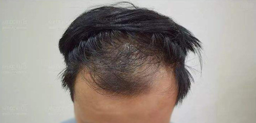 植发两年后又掉光了
