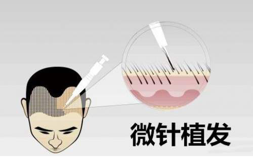 微针植发