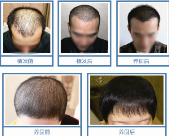 植发后养护过程效果对比