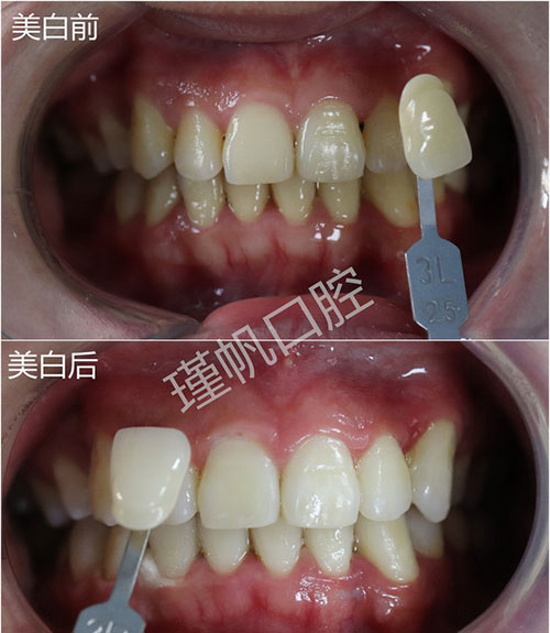 桂林瑾帆口腔医院牙齿美白案例