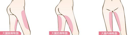 女性大腿吸脂施术部位