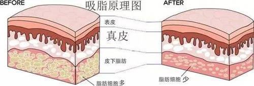 吸脂原理图