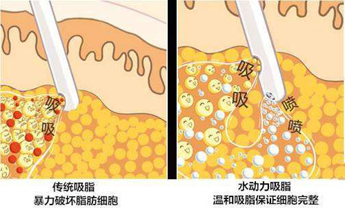 传统吸脂技术和水动力吸脂比较