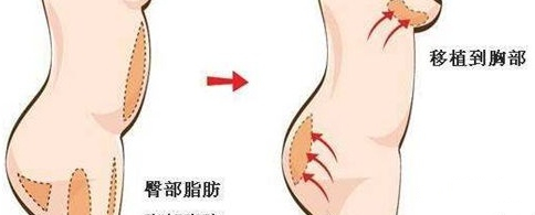 自体脂肪隆胸吸脂部位