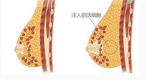 自体脂肪隆胸注入脂肪活细胞效果